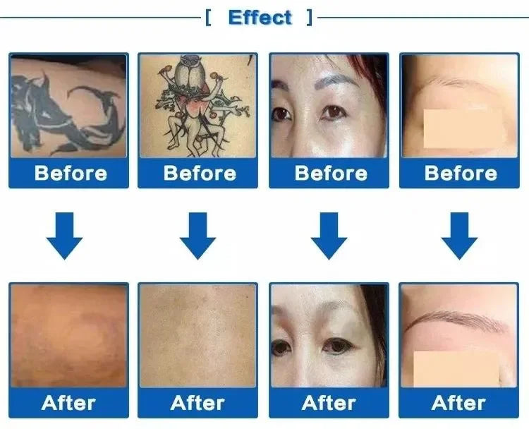 2000W Q Switch Nd Yag Laser Carbon Peeling Therapy Tattoo Pigment Removal Skin Whitening Picosecond Beauty Machine For Salon luvshop24