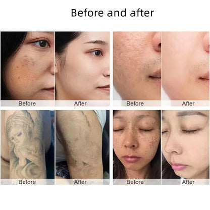 2000W Q Switch Nd Yag Laser Carbon Peeling Therapy Tattoo Pigment Removal Skin Whitening Picosecond Beauty Machine For Salon luvshop24